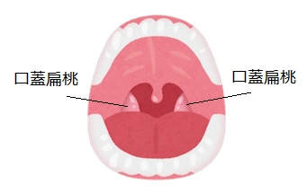 扁桃腺の画像